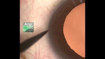 Cataract surgery : How to create a better 3-plane clear corneal incision by Dr. Bryan Hung Yuan Lin