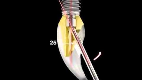 Neo Angle Drive - More advanced than Nobel Bio