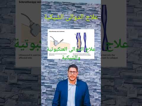 علاج الدوالى العنكبوتية والشبكية علاج الدوالى ليزر حقن