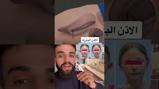 الاذن البارزة طب صحه تجميل