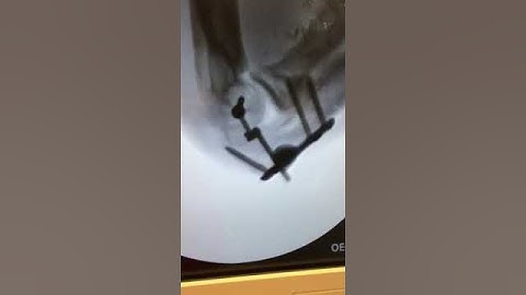 Internal Joint Stabilizer