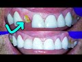 Broken front tooth repair by a dentist how to fix a crown fractured at gumline