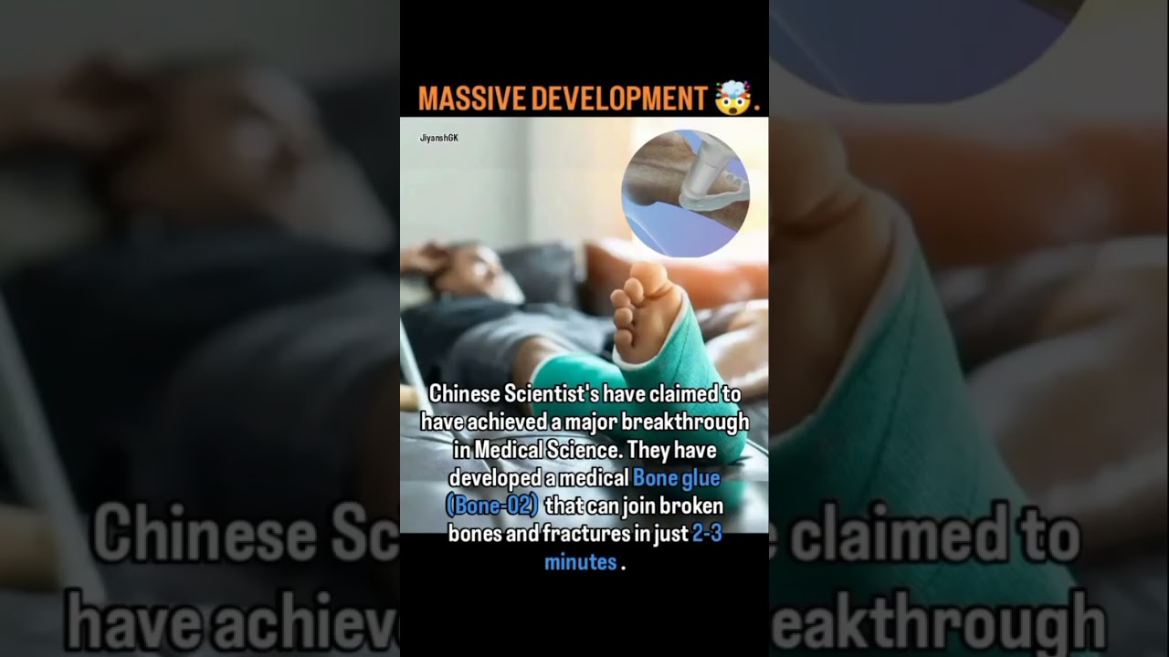 Chinese Scientist's developed Bone glue (Bone-02).