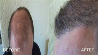 Dr Woods Technique "Aero" - 2000 Donor FUE