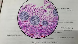 acute appendicitis #histopathology, #pathology,