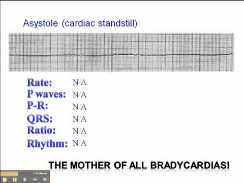 Ecg Asystole Youtube