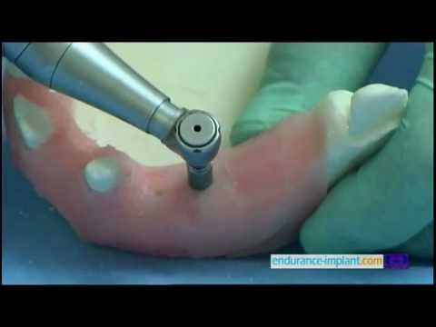Vidéo: Valentina a des implants dentaires