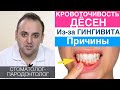 Кровоточивость десен из-за гингивита. Причины, механизм появления, лечение гингивита