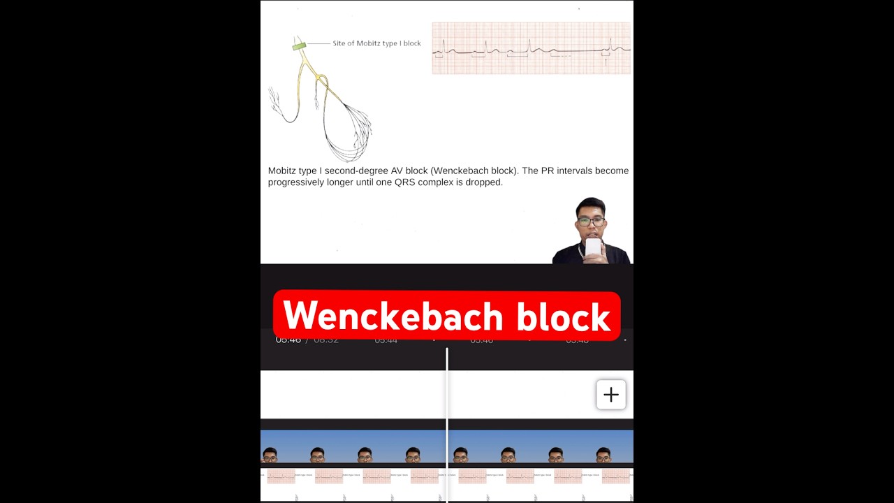 Mobitz type-1 heart block