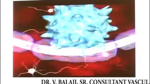 APOLLO HOSPITALS, INDIA -THE NEW CCSVI [LIBERATION] TREATMENT FOR MULTIPLE SCLEROSIS