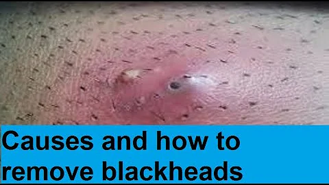 causes and how to remove blackheads