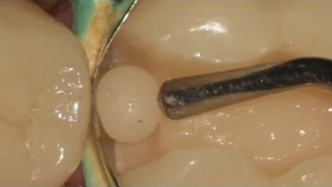 Proximal Restoration in Posterior Tooth