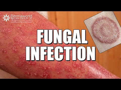 Video: Bakit Lumalabas Taun-taon Ang Mga Sakit Na Fungal Ng Mga Halaman