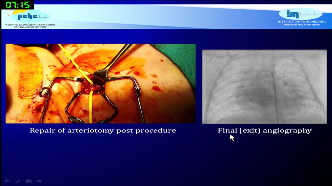 PDA stenting in PA/VSD