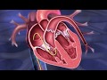 CardioMEMS program at University Hospitals