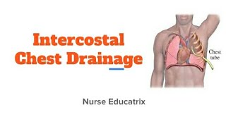 Intercostal chest drainage/ chest drainage system/ICD/ Water seal drainage