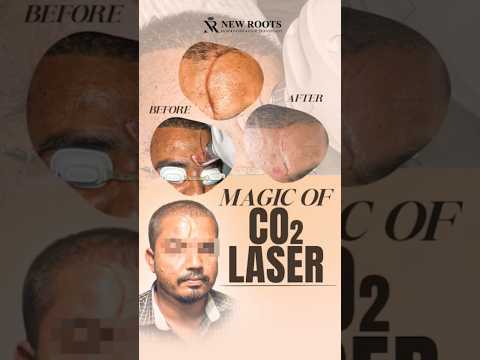 CO2 Laser Scar Removal Treatment ✨ | Chhatrapati Sambhaji Nagar #shorts #ytshorts