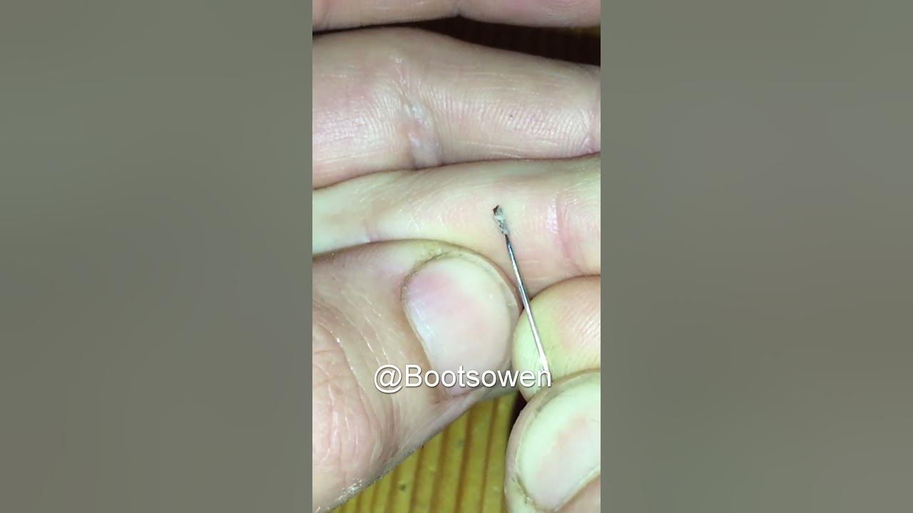 Huge splinter in my finger easily removed with pin and tweezers NO PAIN