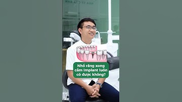 Cắm Implant thay thế răng bị mất có những lưu ý gì? #nhasycuaban #nhakhoa #implant #trongrangimplant