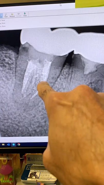 An introduction to tomorrow’s case. #dentists #dentalartistry #hygienist #dentalprocedure #dentist