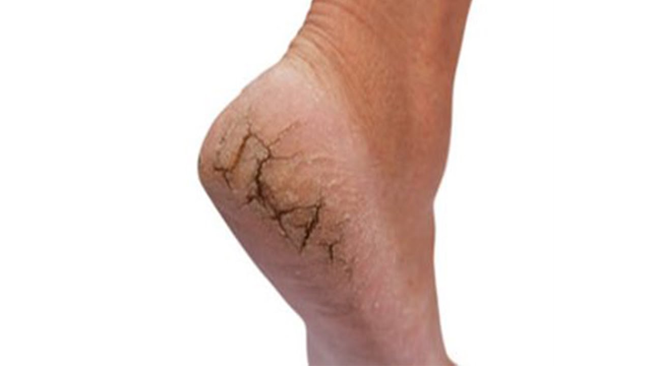 remede gercure pied remede gercure pied