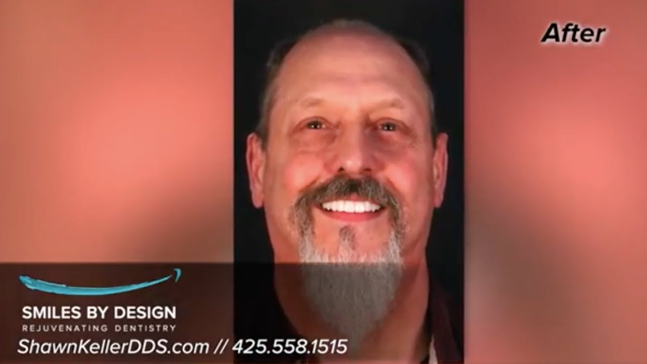 Dental Patient Sharing His Smile Makeover Journey