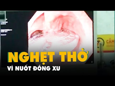 Video Cấp cứu bé gái 6 tuổi trước nguy cơ nghẹt thở vì nuốt... - youtube