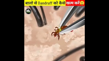 How to remove dandruff 🥺 😠 #shorts #youtubeshorts