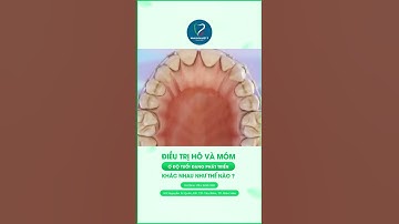 Niềng Răng Hô Móm I Bác sĩ Nguyễn Đình Dương