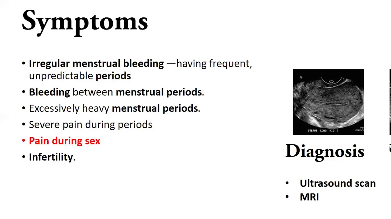 Endometrium,Uterine polyps,Endometriosis,Chocolate cysts reason and