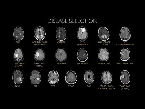 RFS AI Journal Club : AI System Approaching Neuroradiologist-level Differential Diagnosis Accuracy