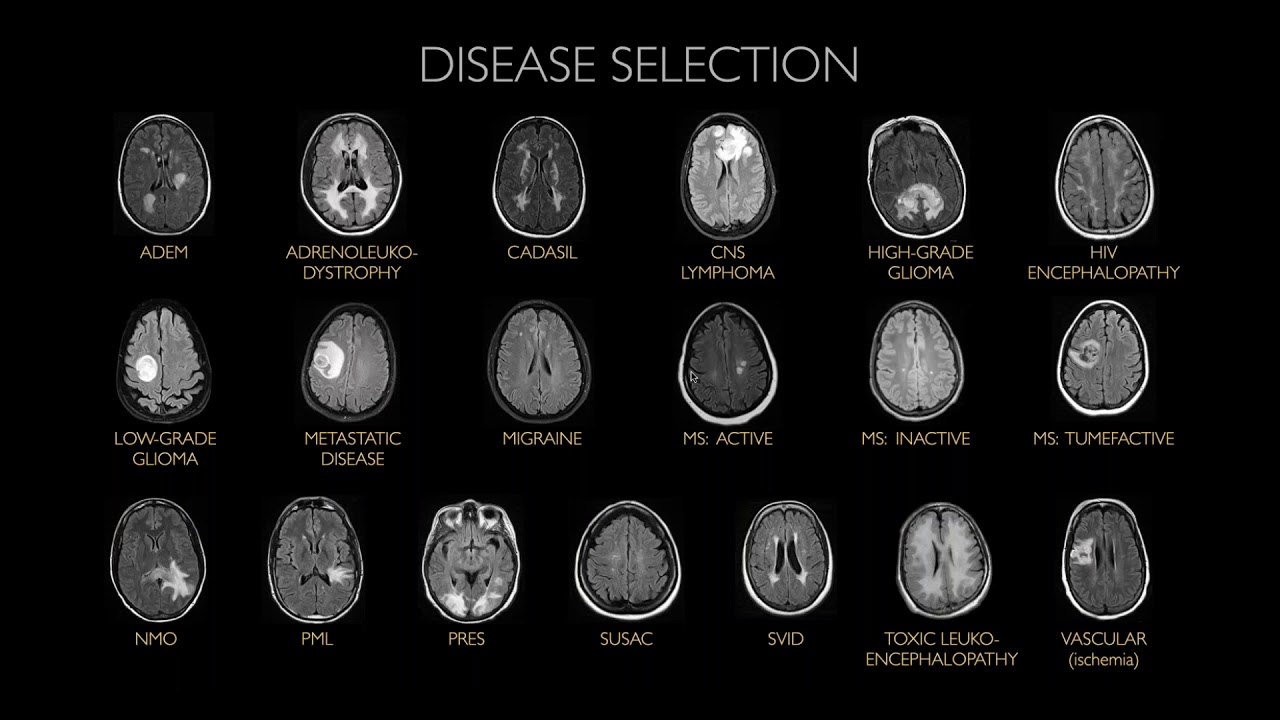 RFS AI Journal Club : AI System Approaching Neuroradiologist-level Differential Diagnosis Accuracy