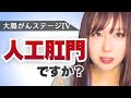 【大腸がん】人工肛門についてお話します