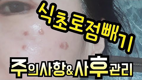 식초로 점빼기 4일차~주의사항&사후관리