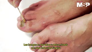¿Cómo se producen los hongos en las uñas? - #ExclusivoMSP