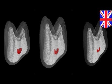 Self-healing teeth? UK scientists develop new pain-free cavity treatment