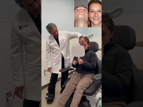 Video thumbnail: Correcting an Extremely Deviated Nose — 1 Week Rhinoplasty Reveal #reveal #reaction #rhinoplasty · Dr. Manish H. Shah