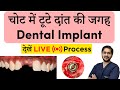 Live dental implants surgery        dr ankit khasgiwala  indore