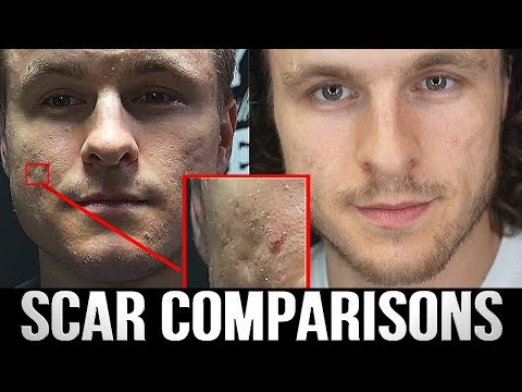 MY ACNE SCAR TREATMENT RESULTS TWO YEARS LATER | Realistic Expectations