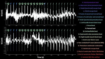 RealTime Electrocardiogram MIT-BIH Arrhythmia Database N°104 with tag anotations.