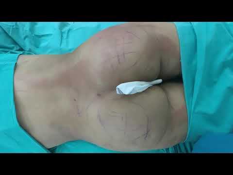 Popoya Yağ Enjeksiyonu BBL Gluteal Augmentation | Op. Dr. Arda Katırcıoğlu