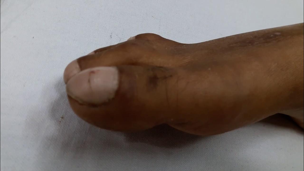 clubbed-foot-nails-clubbing-of-nails-youtube