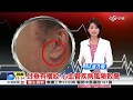 ✅【苦行健康】從耳垂看出心肌梗塞前兆blood vessels？！苦行老師教您如何自醫。