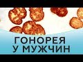 Гонорея у мужчин. Лечение гонореи