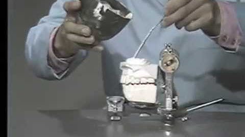 Mounting the Maxillary Cast on the Articulator