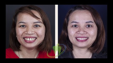 Digital Smile Design - Thiết kế răng sứ cho trường hợp răng thưa và hình thể dị dạng