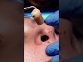 Macro Nose Pore Cleaning | Clinical ASMR 4K #macroasmr #macroextraction #satisfyingskincare