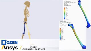 How Medical Implants are Designed using Ansys Mechanical