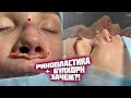 Сочетание операций ринопластика и булхорн. В чем смысл?