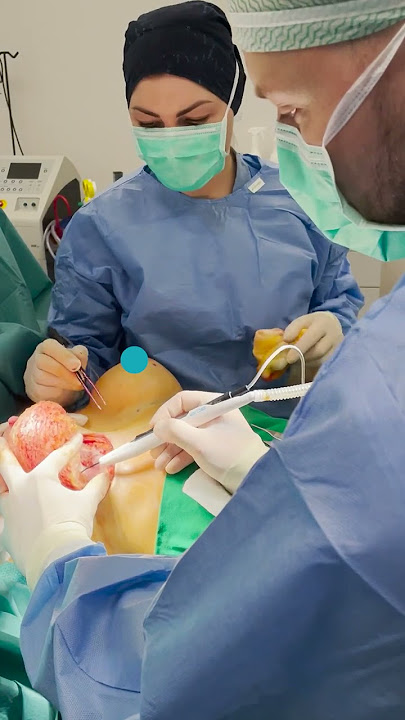 Plastic surgeon G. Samulenas removing breast implants for a patient with capsular contracture.